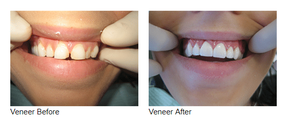 Porcelain Veneers Porcelain Veneers